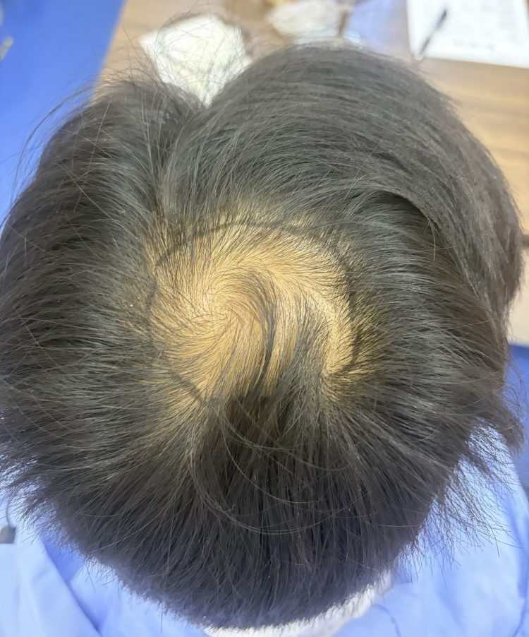 香港人注意！頭髮掉不停係正常換季定真脫髮？深圳鵬程植髮教你分辨