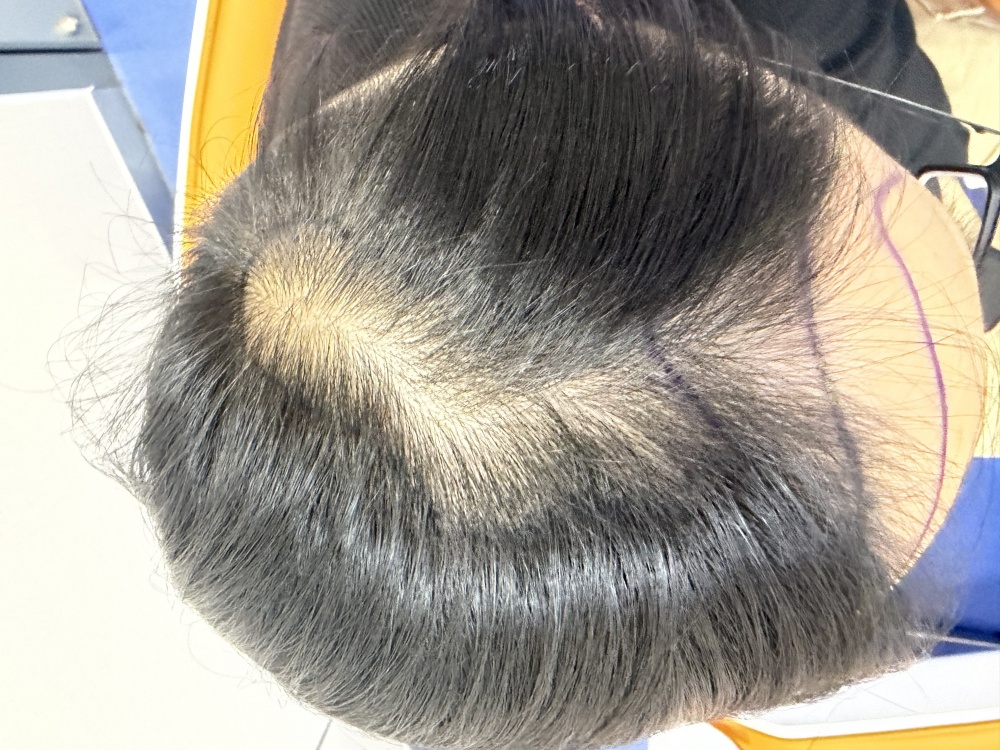 宝妈脱发