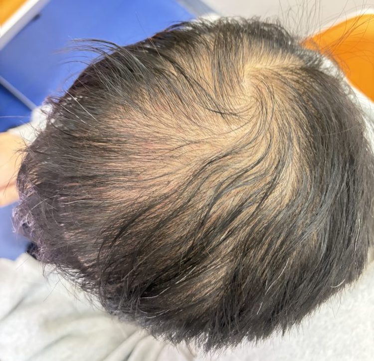 香港脫髮救星｜頭髮掉得厲害怎麼辦？深圳鵬程植髮醫院教你 4 招解決✅