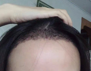 追本溯源！植髮失敗的 3 大核心原因及規避技巧｜深圳鵬程植髮醫院專業建議