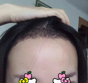 植髪失败