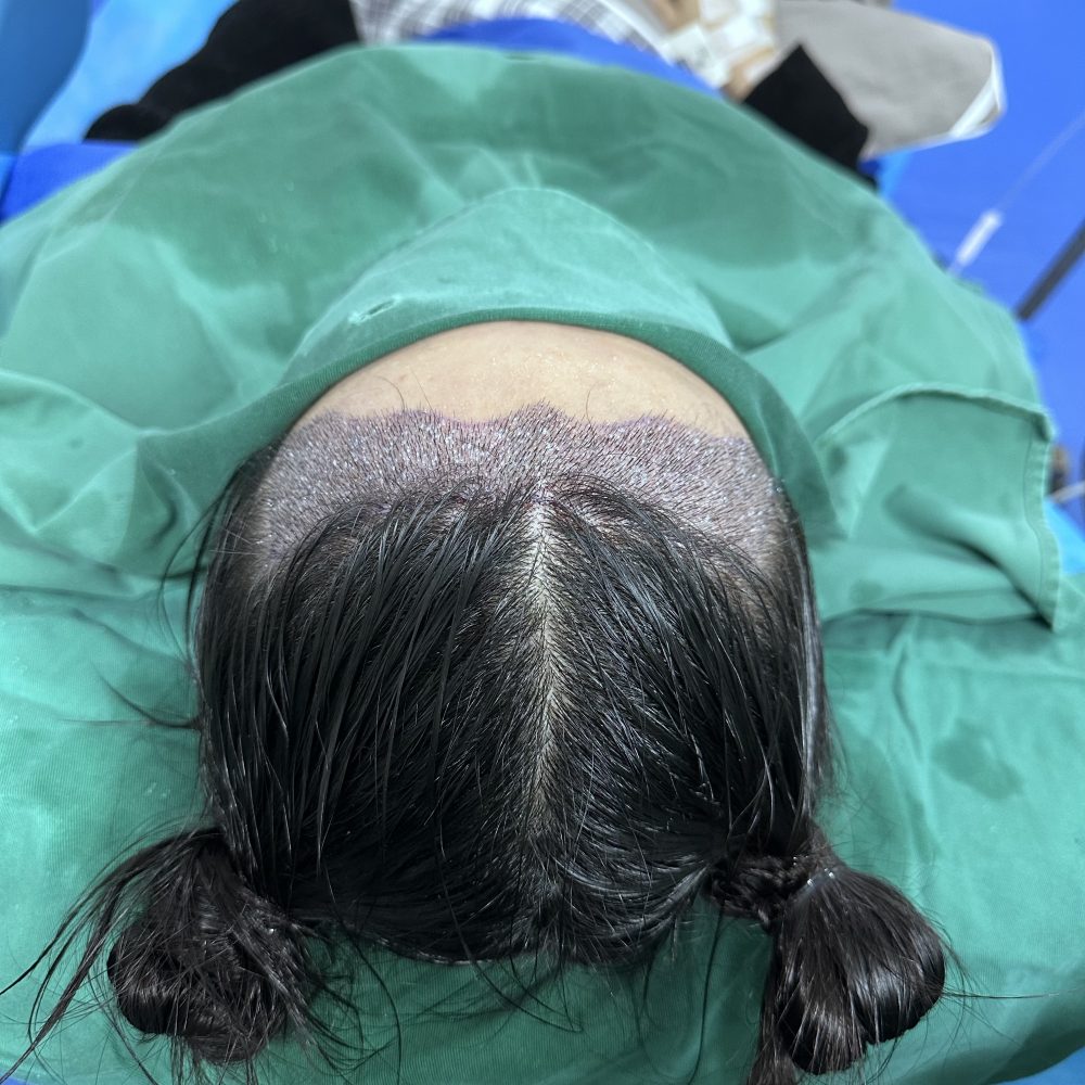 香港打工仔必看！脫髮分級速測｜幾級脫髮？種多少毛囊？深圳鵬程植髮醫院解答