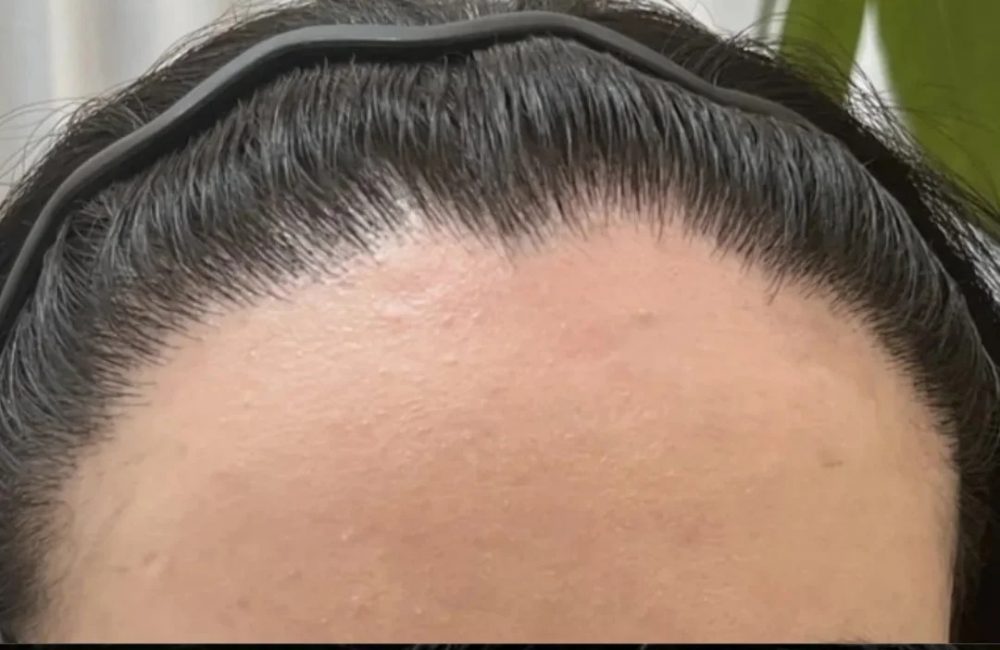 植髮失敗唔使慌｜最全補救指南 識揀醫生 + 正確護理 香港髮友都適用 深圳鵬程植髮醫院