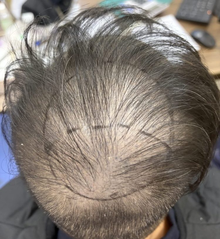 ⚠️港人每 6 個就有 1 個脫髮！識分脫髮類型先唔好亂護髮｜深圳鵬程植髮醫院話你知