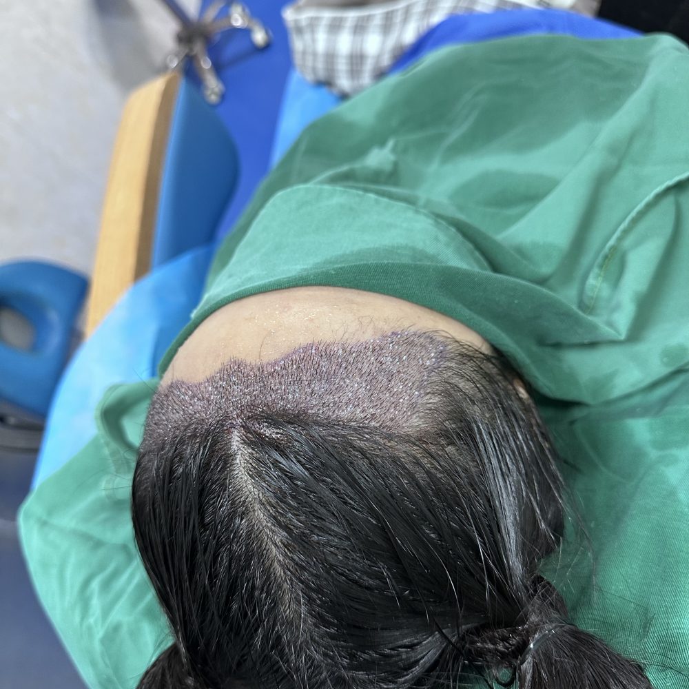 脫髮治療揀藥物定植髮？｜早用藥晚植髮黃金法則｜深圳鵬程植髮醫院