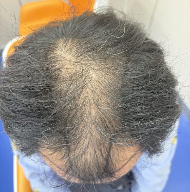 香港髮友解惑：米諾地爾 + 非那雄胺用咗冇效果？深圳鵬程植髮醫院教你點做