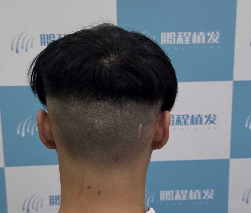 後枕部毛囊真的「取之不盡」？深圳鵬程植髮提醒：這個資源雷區千萬別踩