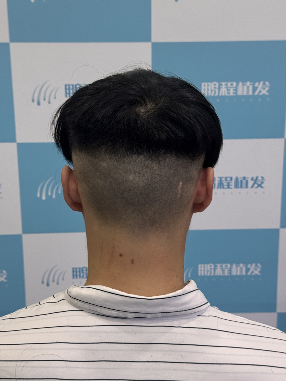 后枕区