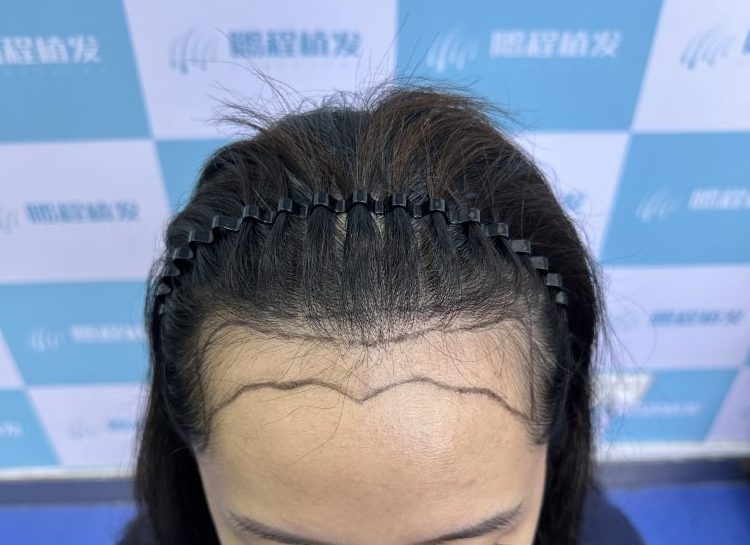 植髮避坑指南 2026｜手術前必知真相｜毛囊存活率｜價格陷阱全拆解