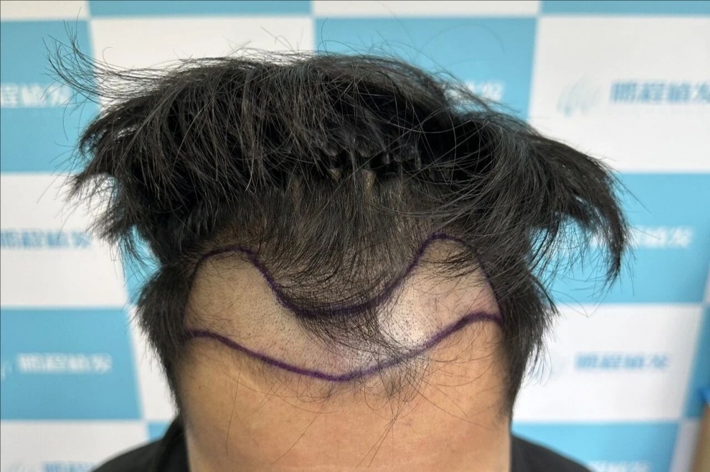 M秃