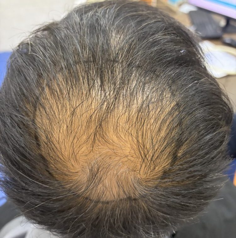 深圳植髮成功率高唔高？選對機構先至有保障｜香港髮友必看指南