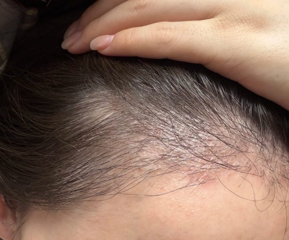 深圳植髮後不久掉髮？唔使驚！教你分清正常脫落同植髮失敗