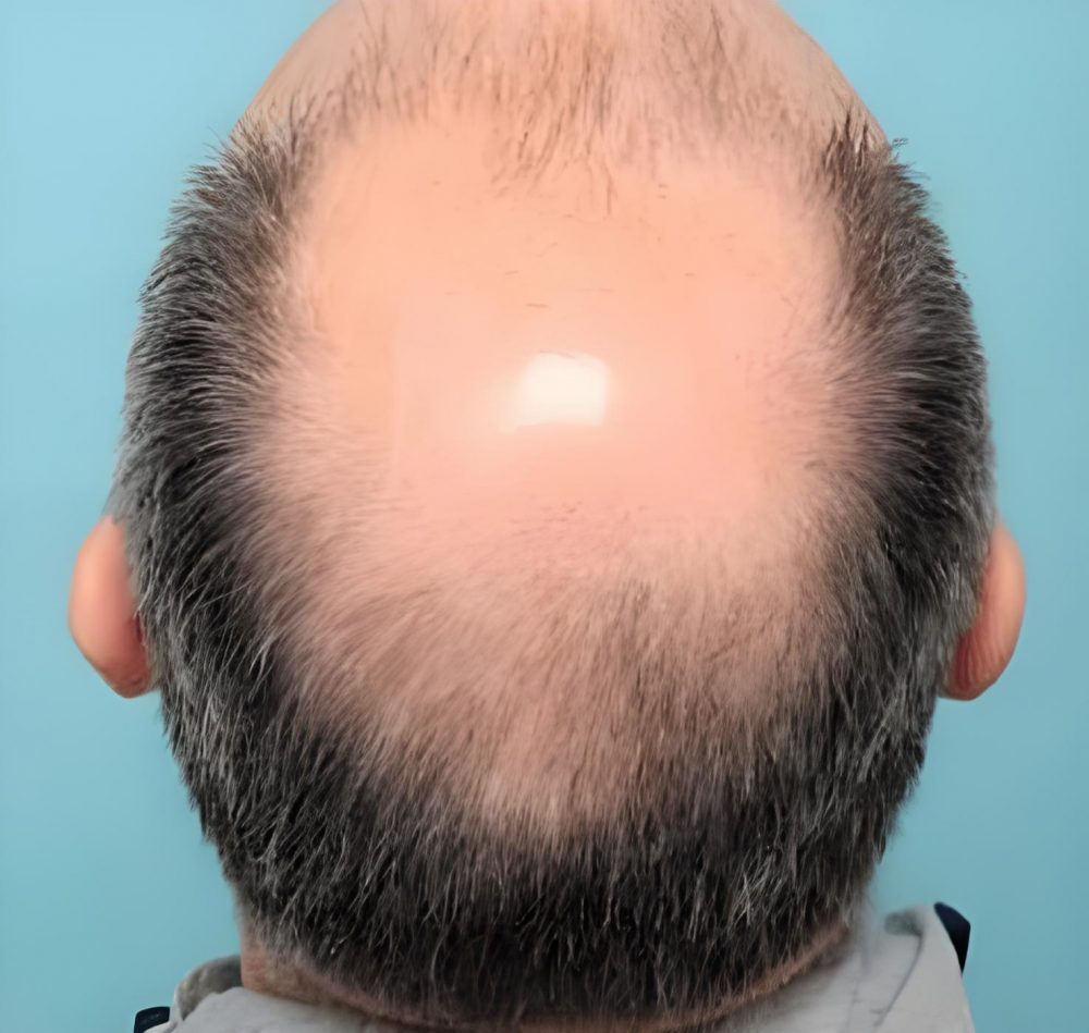 深圳植髮毛囊不夠怎麼辦？4個救命方案，香港髮友必看｜深圳鵬程植髮醫院