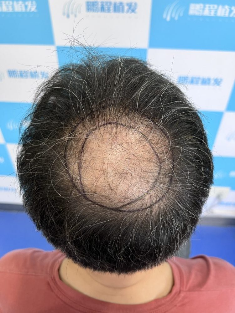 雄激素性脫髮