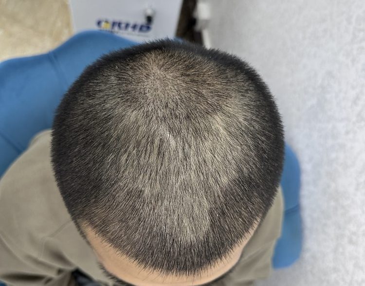 深圳植髮後恢復比人慢？拆解4大原因+護理秘訣，香港髮友必看