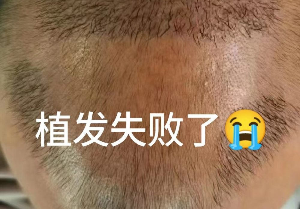 深圳植髮失敗唔使慌！3步專業評估+補救方法，香港髮友必睇