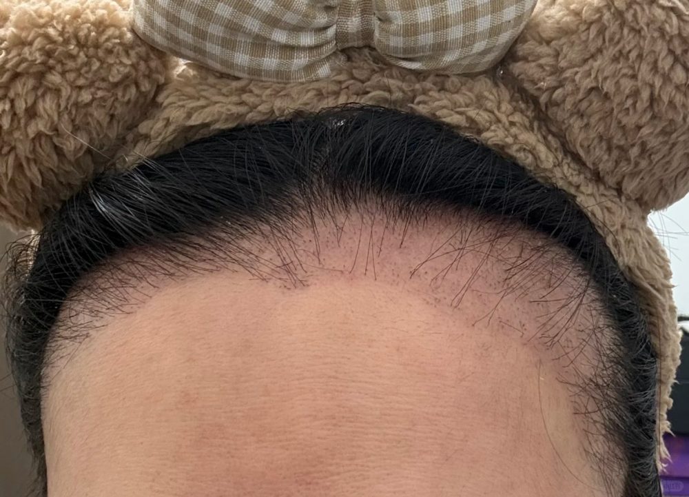 香港植髮失敗補救方法｜毛囊存活率低、髮際線不自然怎樣修復？深圳鵬程植髮醫院指南