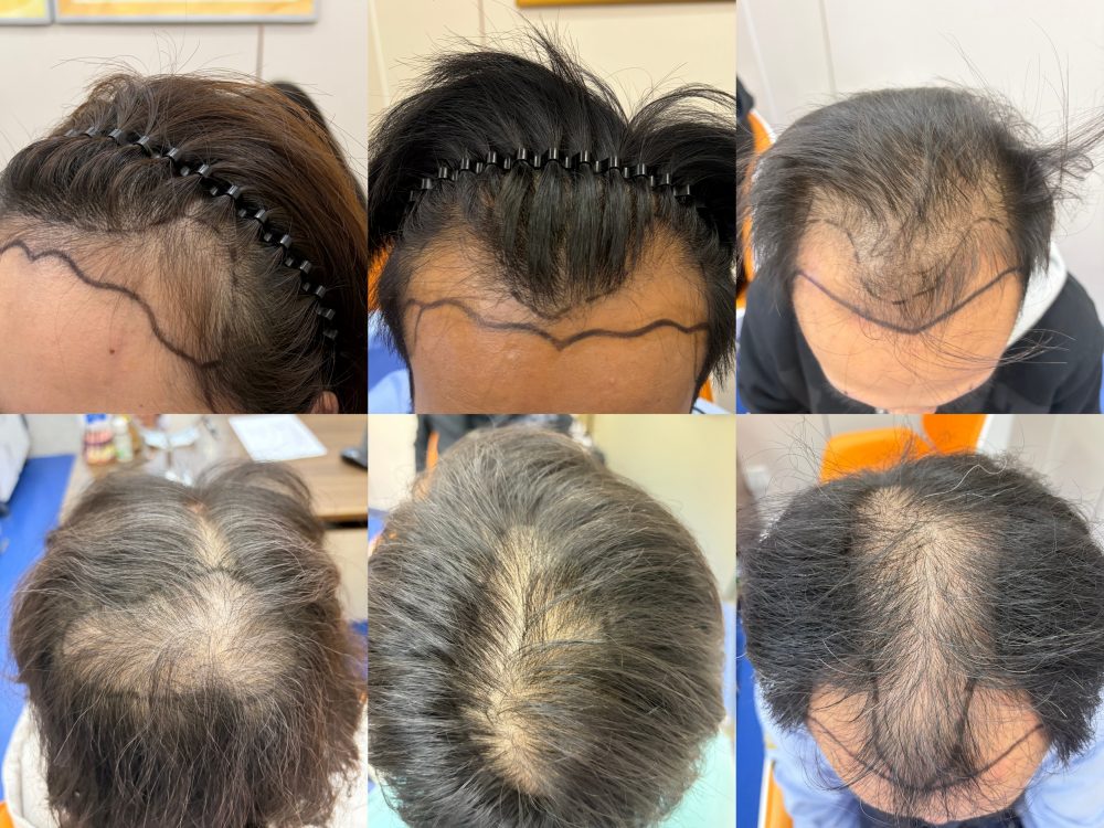 香港雄脫自救指南｜男性M型脫髮、女性髮縫變寬必看，不用再怕发际线後移