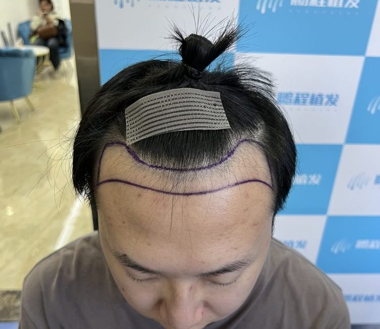 香港植髮靠譜嗎？成功與失敗原因大公開，選對機構先至唔會走冤枉路