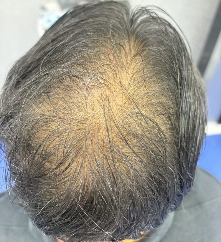 香港人脫髮原因大公開！3種常見脫髮類型+自查方法，唔使再驚頭髮越來越少