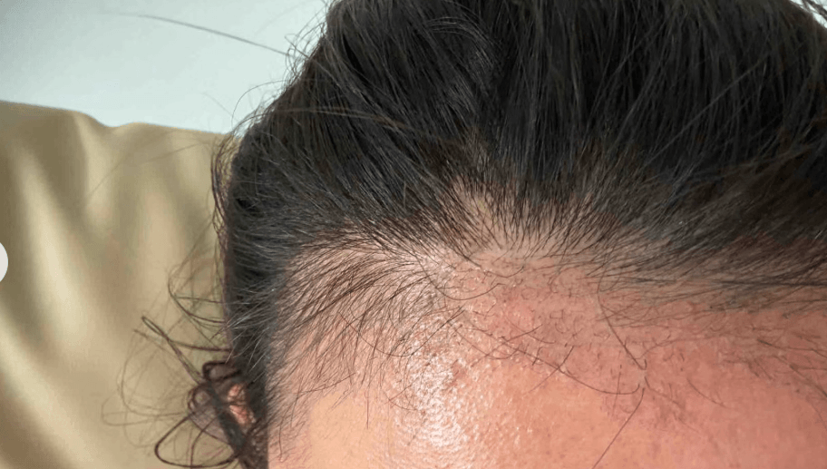 香港植髮失敗可补救？修復方案全解析，二次植髮+非手術方法一文睇懂