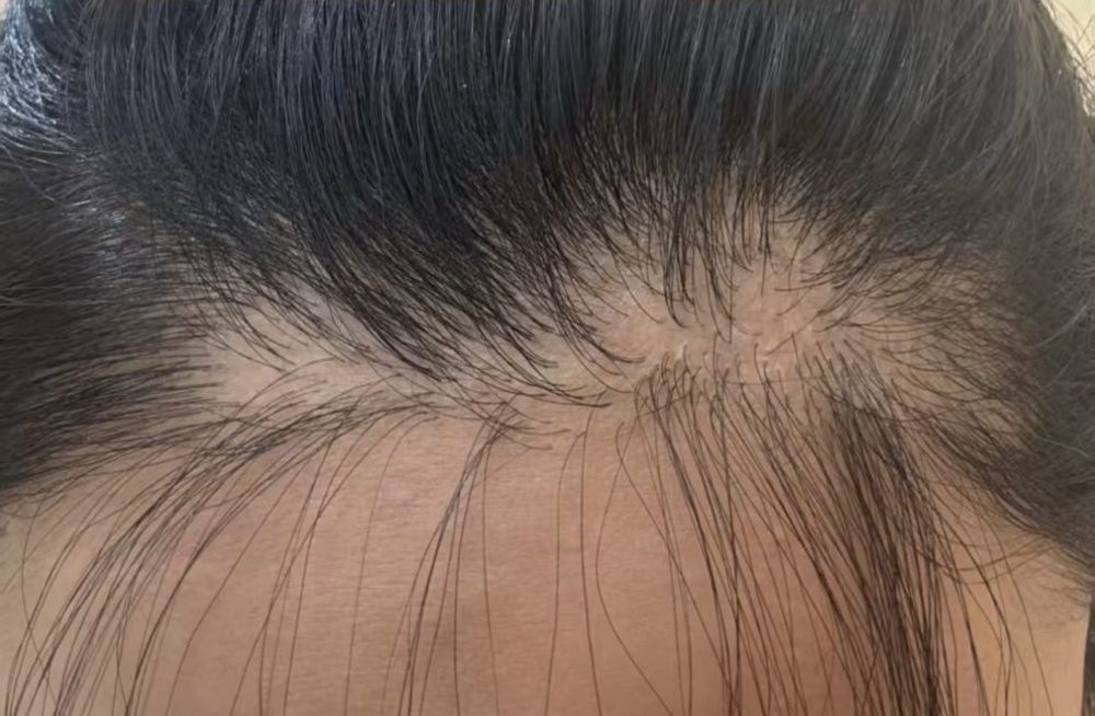香港植髮失敗常見類型｜原因分析+判斷時間，避免踩坑必看