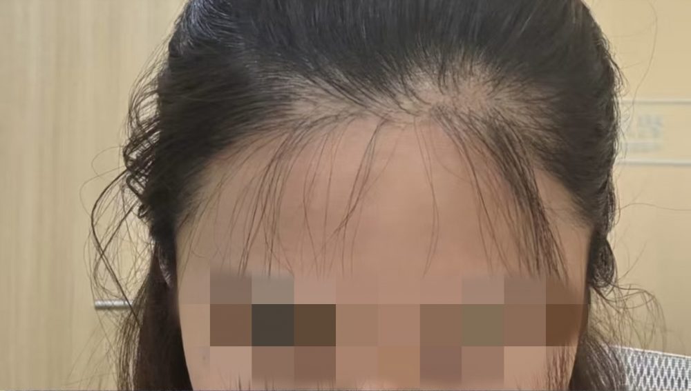 香港植髮失敗修復方案｜技術選擇指南，二次植髮避坑必看