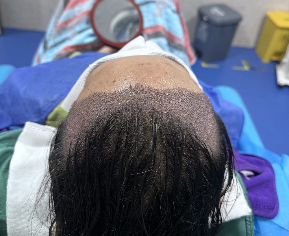 香港植髮常見誤區大盘點！90%香港髮友踩過，看完慳返冤枉錢