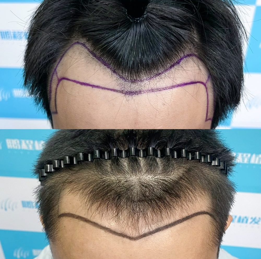 香港植髮髮際線挑選指南！如何揀適合自己嘅形狀？不踩雷攻略