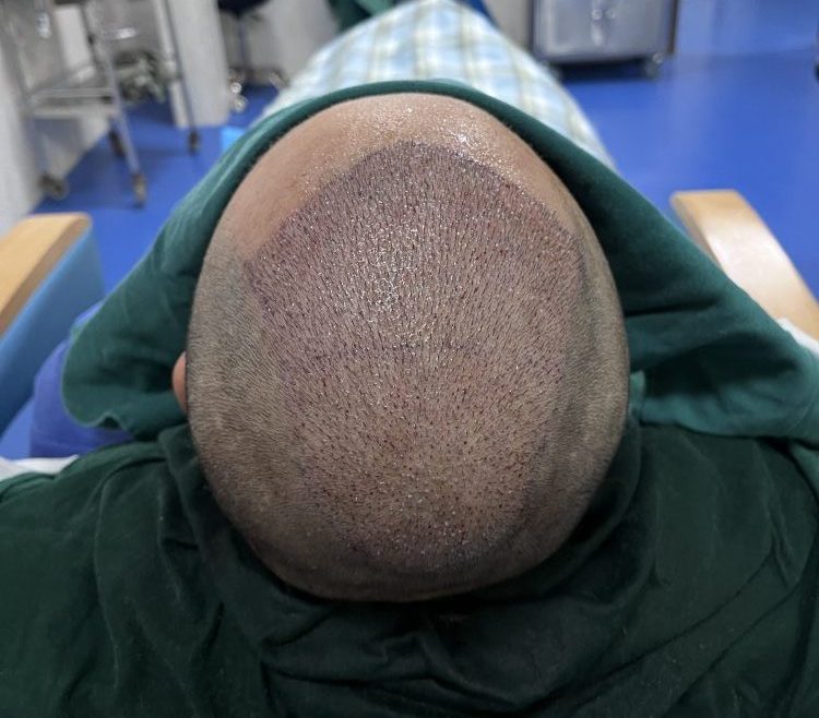 香港植髮全攻略｜植髮原理、適合人群、技術選擇+避坑指南 深圳鵬程植髮醫院推薦