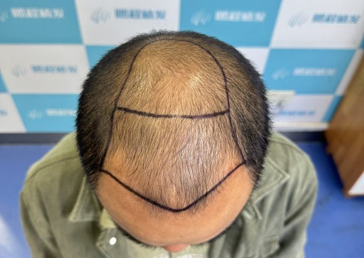 香港髮友必看｜深圳植髮價錢大全 毛囊單位收費+費用影響因素 深圳鵬程植髮醫院