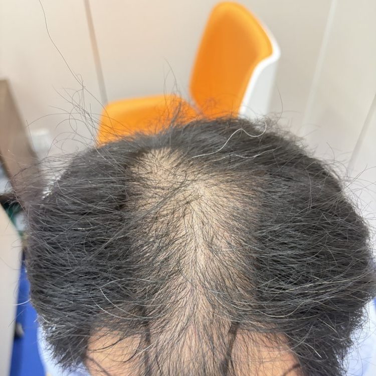 香港脫髮原因大公開｜每日掉髮幾多先算正常？雄脫、休止期脫髮分清楚