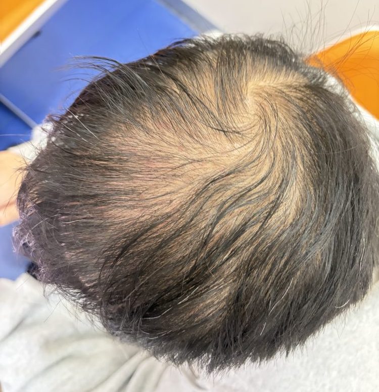 香港脫髮自救指南｜藥物治療vs生活干預，植髮時機幾時最適合？