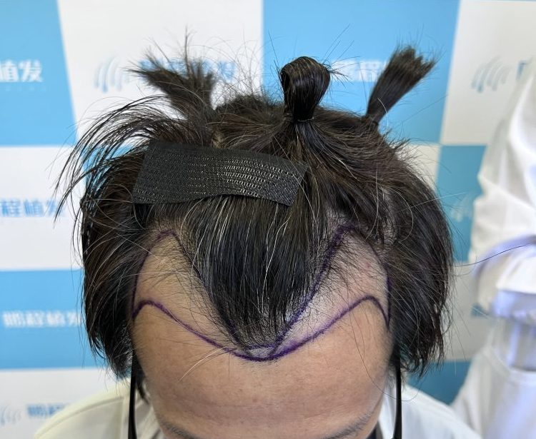 香港植髮全攻略｜植髮原理、技術對比、術後護理，邊種植髮技術最適合你？