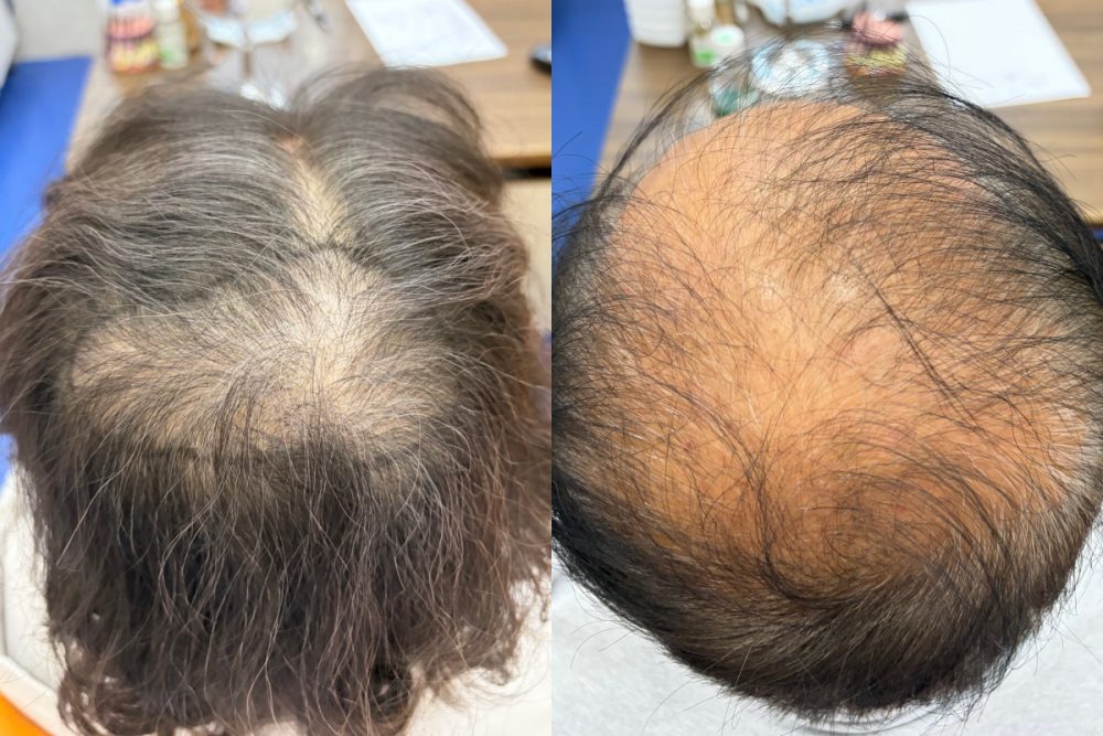 香港髪友解惑：雄激素性脫髮係咩事？有得醫嗎？易唔易醫？