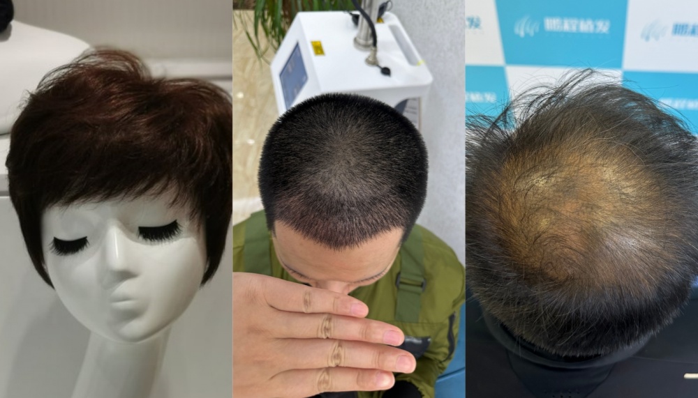 植髮、假髮、紋繡哪個靠譜？