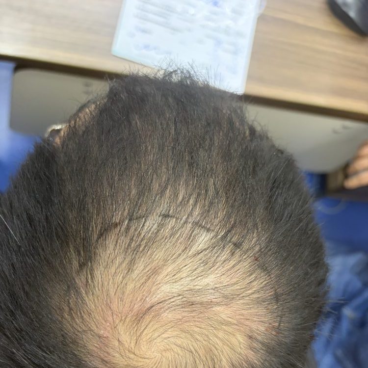 嚇親！香港年輕人三成早秃？唔使慌！呢個科學方法救返你嘅頭髮✅