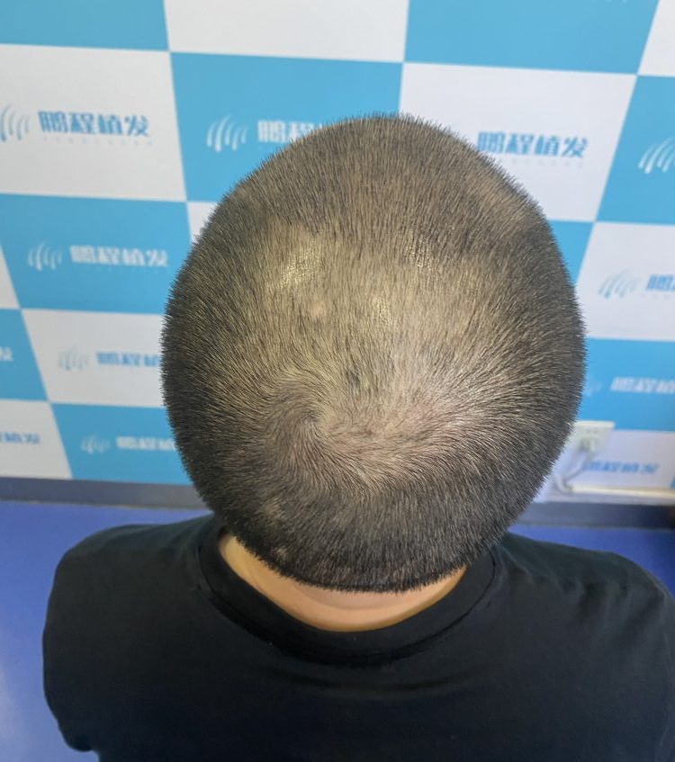 香港植髮邊種技術好？FUE同FUT區別+術前術後注意事項｜深圳鵬程植髮醫院