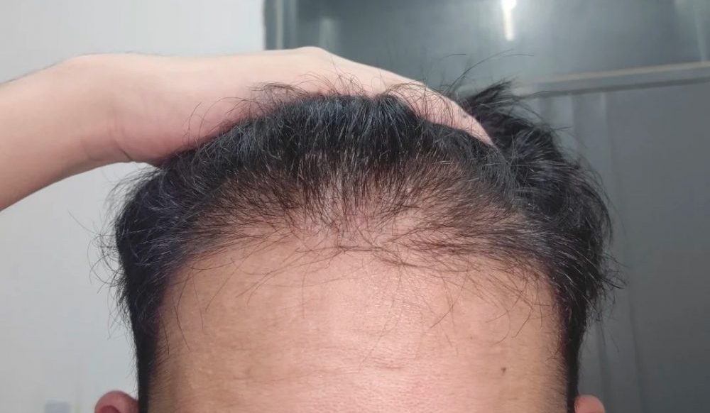 香港植髮失敗點算好？科學修復方法+時機選擇｜深圳鵬程植髮醫院
