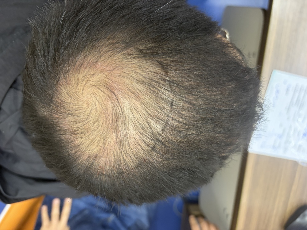 脫髮真相