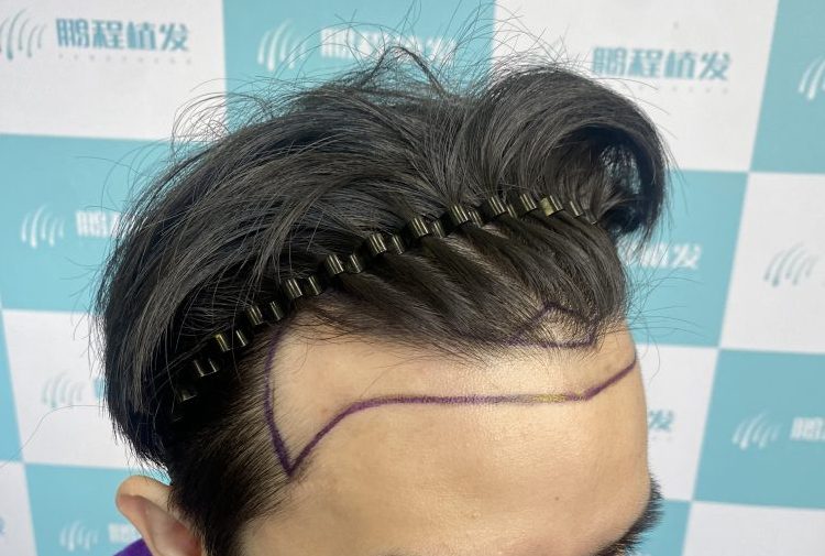 香港脫髮原因大公開！每日掉髮幾多先要驚？植髮邊間好｜深圳鵬程植髮醫院