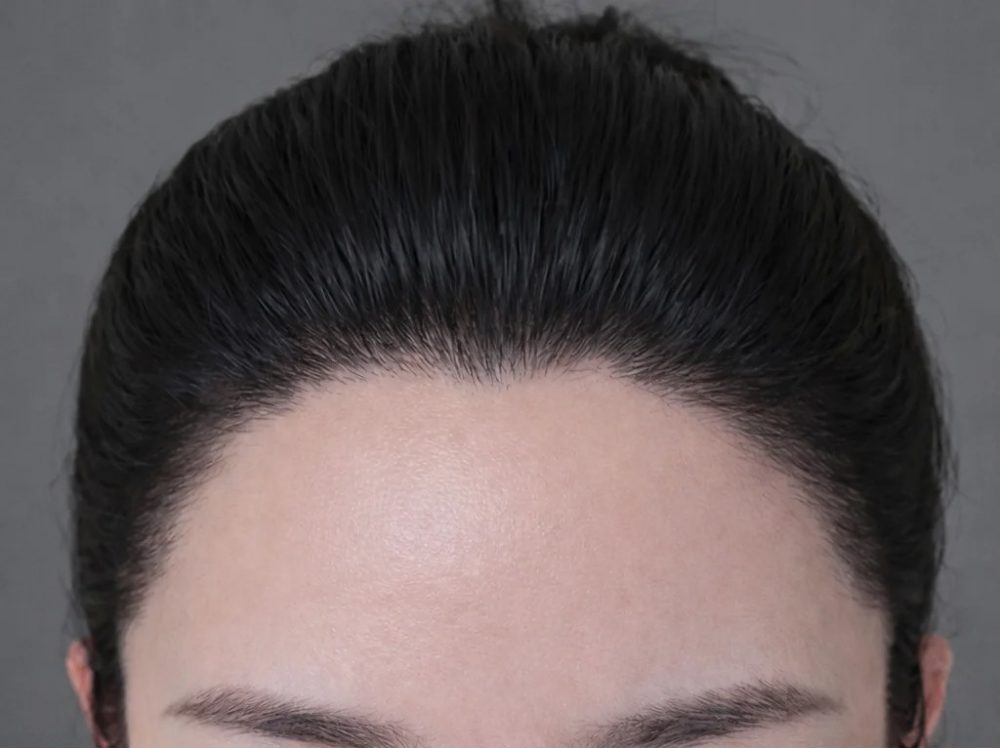 香港植髮失敗點算好？成活率低、假假地怎麼救｜深圳鵬程植髮醫院