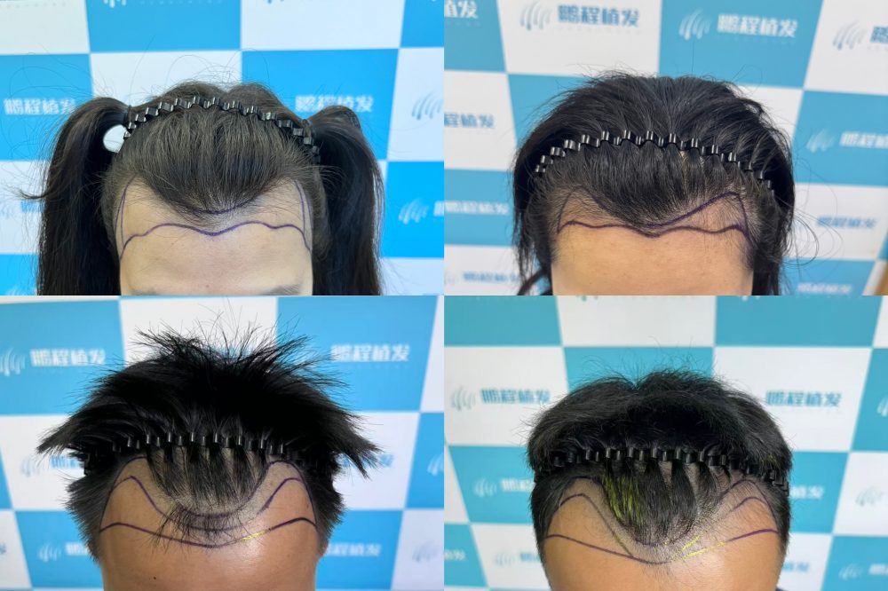 植髮千萬不要去？網上勸退言論真相大公開，90%港人都理解錯咗！