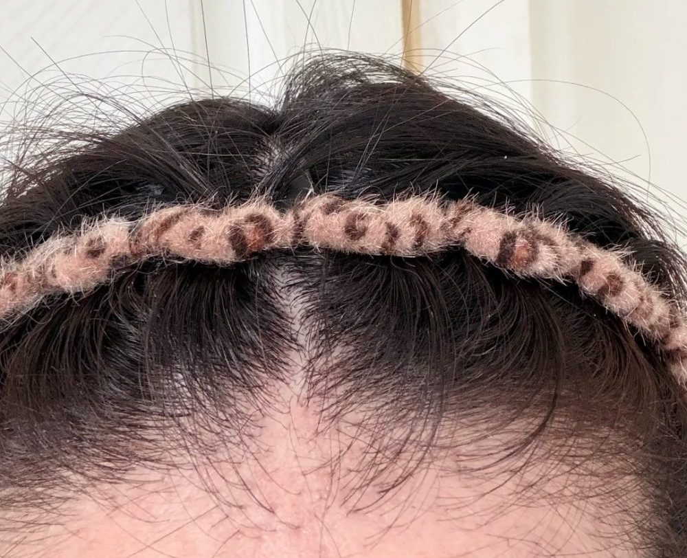 香港植髮「翻車」點算？有得救嗎？教你避坑少走冤枉路！