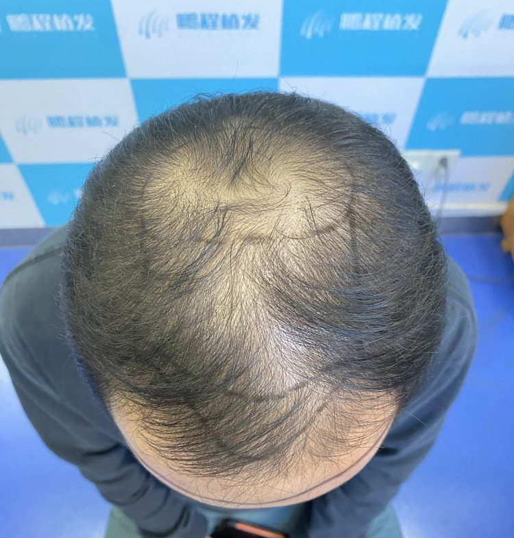 香港脫髮人數破百萬！分清生理性vs病理性脫髮，唔使再盲目防脫｜深圳鵬程植髮醫院