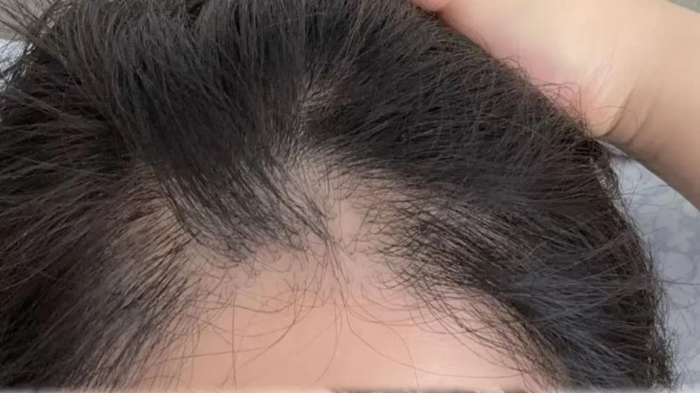 香港植髮效果唔理想？二次植髮+輔助補救方案全解析｜深圳鵬程植髮醫院