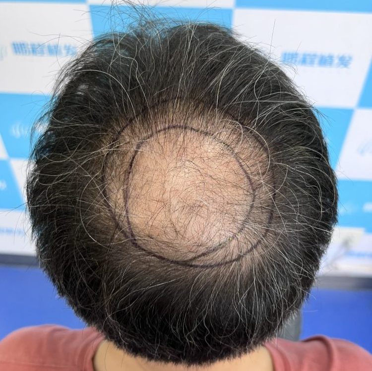 每日掉髮唔止？教你1分鐘分清正常代謝同病理性脫髮｜香港髮友必看