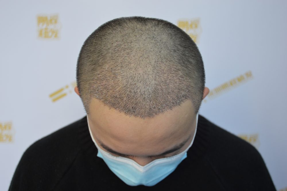 拯救髮際線！香港髮友必看防脫生髮科學指南，避坑不浪費錢