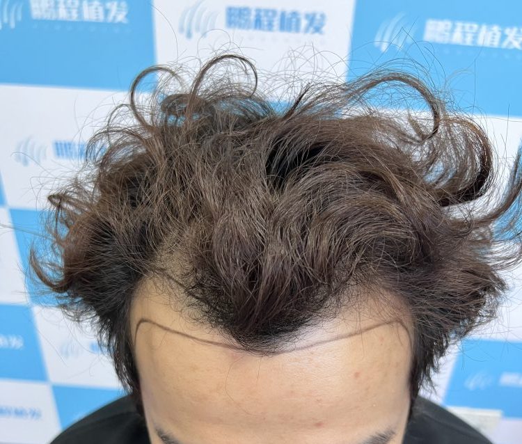 植髮可以一勞永逸？香港髮友必看植髮真相，避坑指南全解析