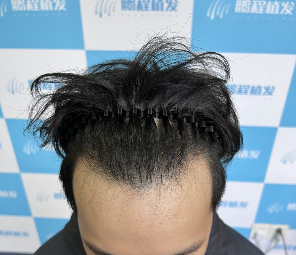 香港年輕人早脫危機｜髮線後移點算好？拆解脫髮成因與改善方法